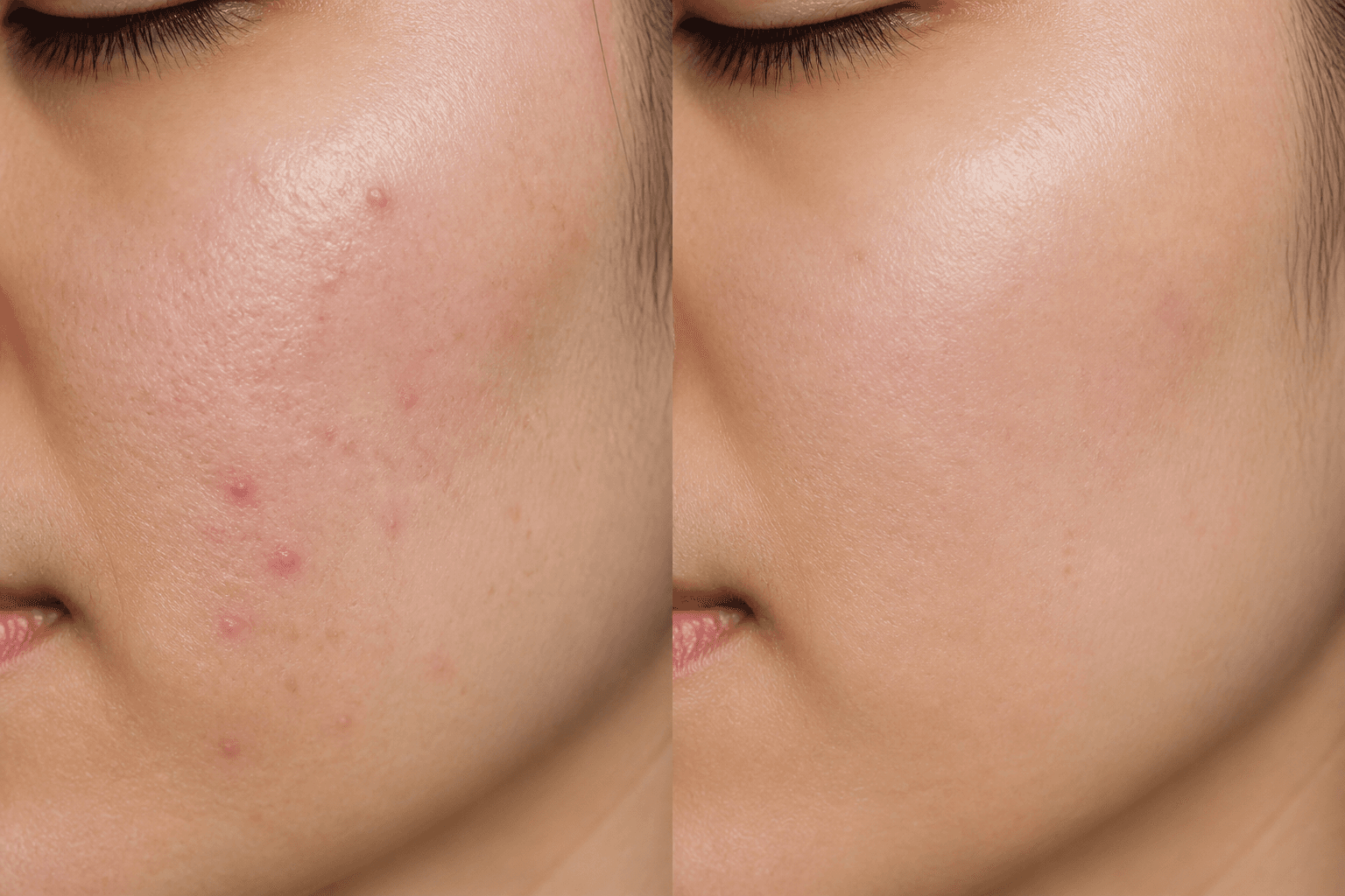Acne Care Progress